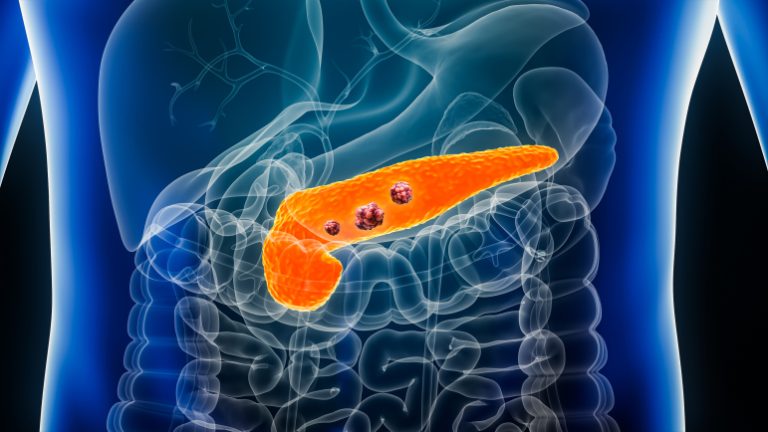 Le daraxonrasib double la survie dans le cancer du pancréas