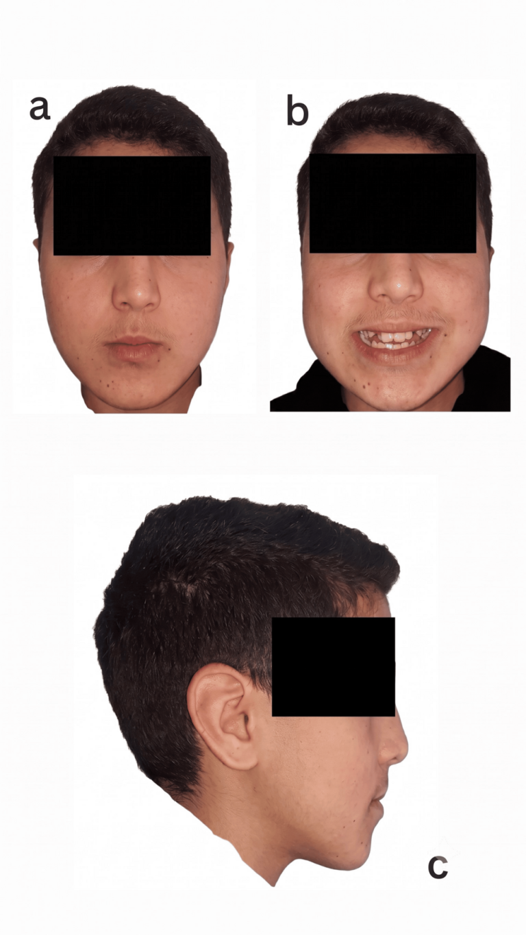 Qu'est-ce qu'une malocclusion de classe III sévère et pourquoi est-elle si difficile à traiter