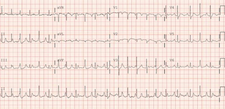 Un cas exceptionnel : fibrillation auriculaire et syndrome de Gitelman