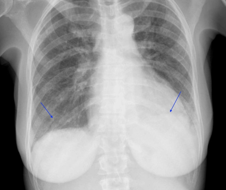 Complications cliniques et soins intensifs dans la sclérodermie systémique