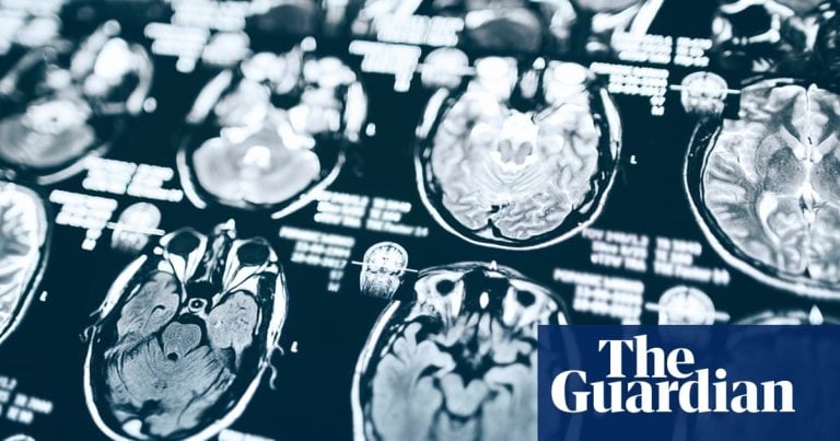 Coupes de Trump : une étude sur Alzheimer à Pittsburgh menacée d'arrêt