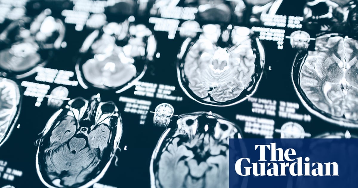 Coupes de Trump : une étude sur Alzheimer à Pittsburgh menacée d'arrêt