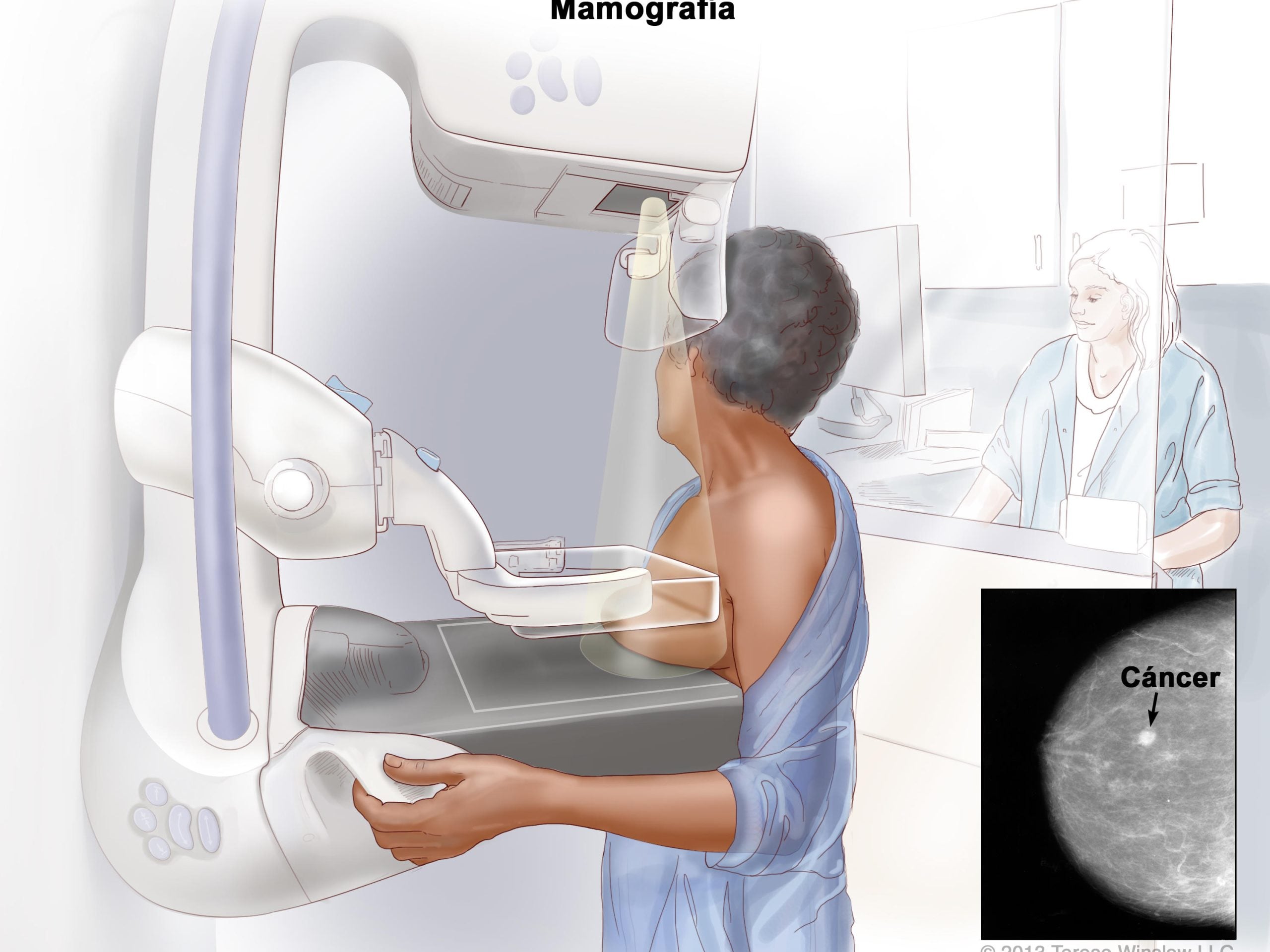 Des Scientifiques Cartographient des Cellules de Cancer du Sein Quiescentes
