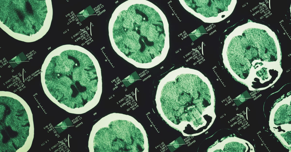 Maladie d'Alzheimer : les modifications cérébrales débutent des années avant