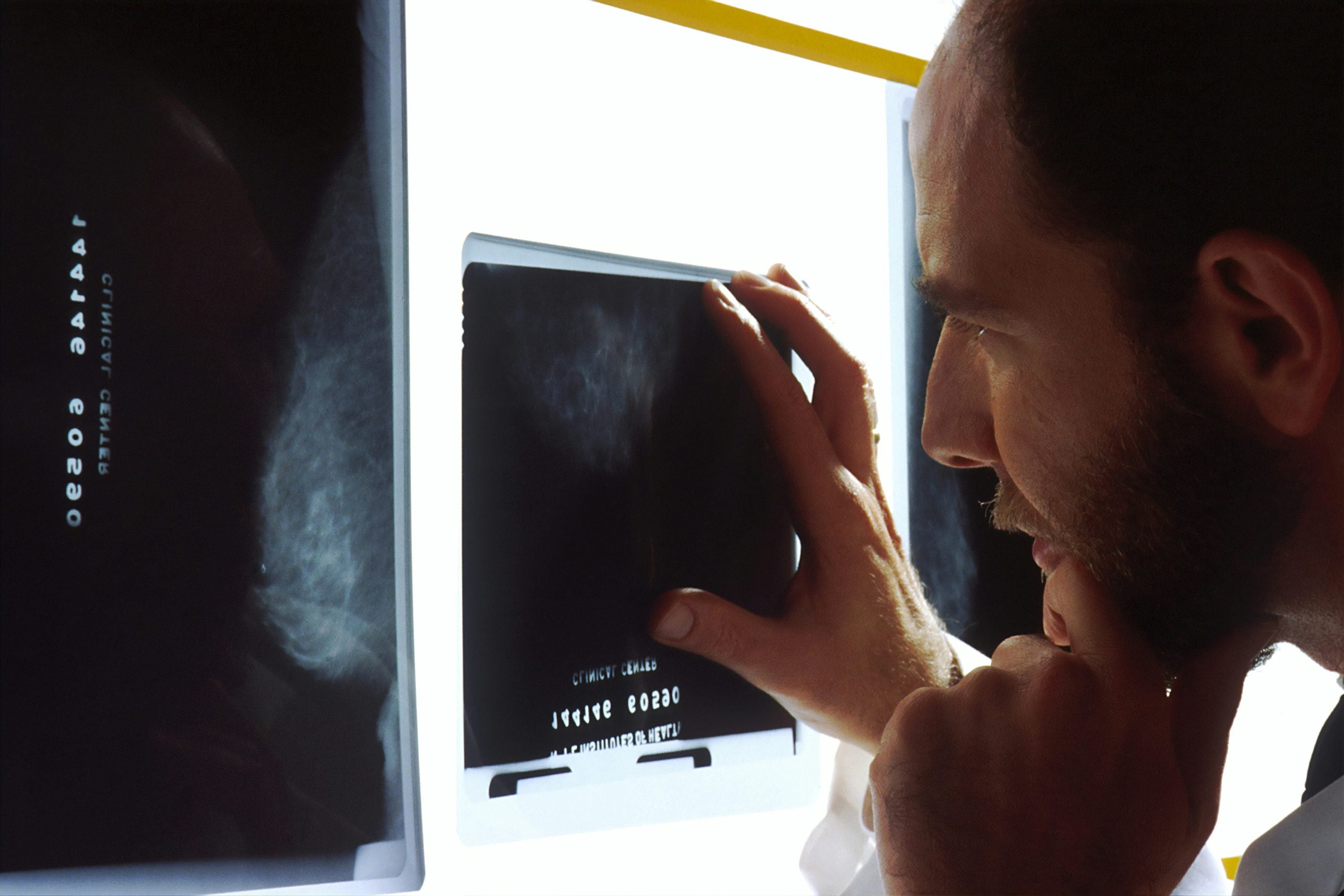 Arrêt Cardiaque : La Coronarographie Immédiate Ne Réduit Pas la Mortalité