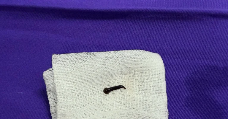 Une sangsue vivante a été extraite du larynx d'une femme à l'hôpital central d'oto-rhino-laryngologie